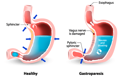 Gastroparesis | Gastrointestinal Society